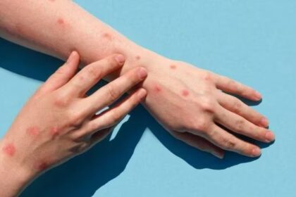 Monkeypox Virus हवा के जरिए भी फैल रहा? जानिए Covid से कितना अलग है ये संक्रमण