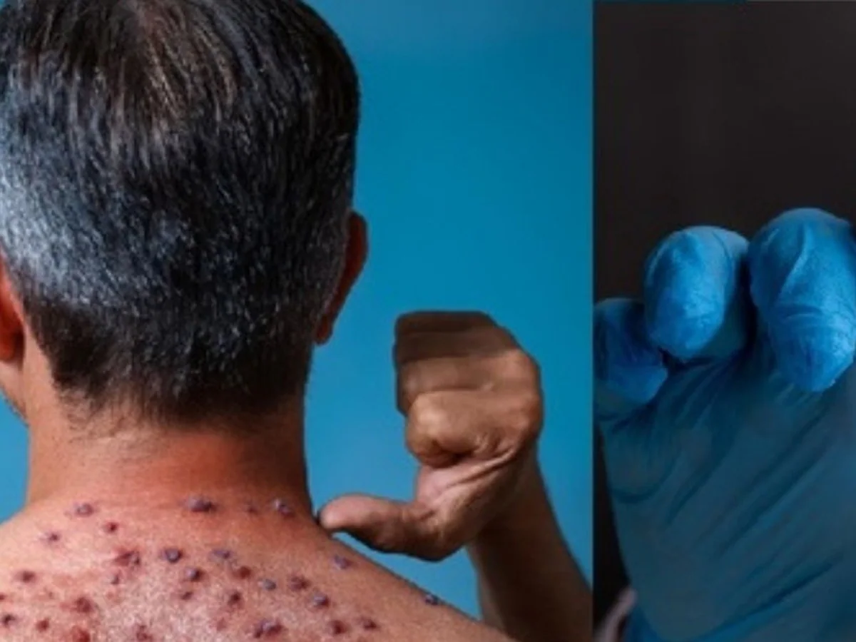 Monkeypox Update: भारत में मिला मंकीपॉक्स का पहला मरीज, जानिए इसके लक्षण