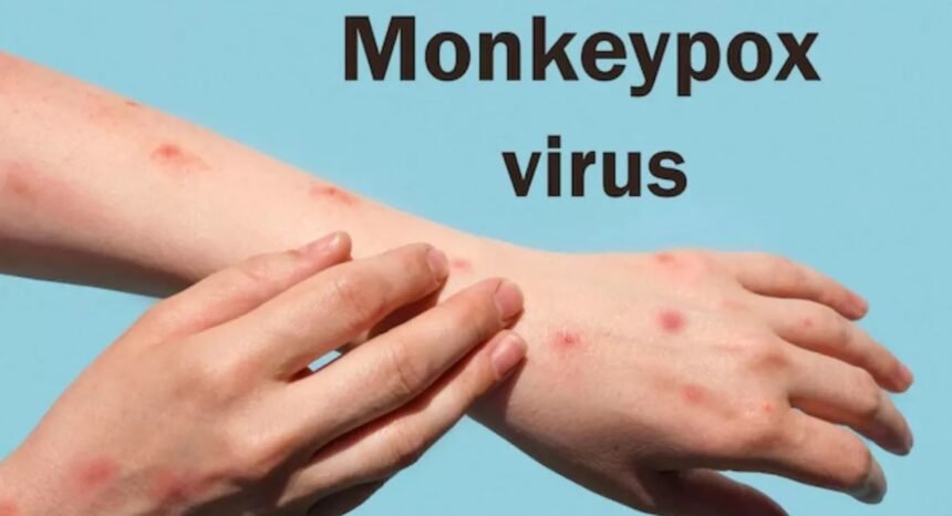 Monkeypox के केस हो रहे कम, लेकिन WHO ने फिर भी किया अलर्ट; जानिए क्‍यों?