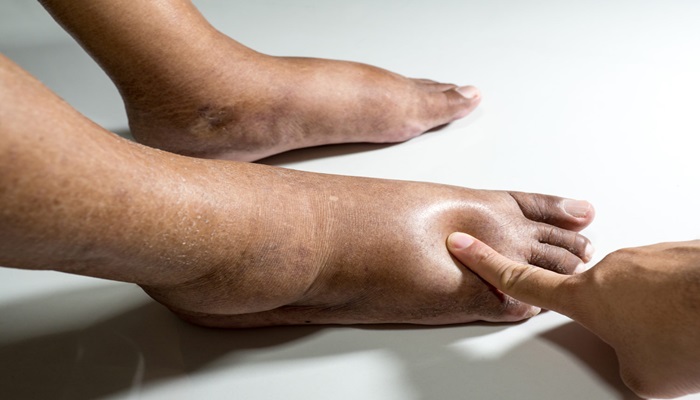 Diabetic Foot: अक्सर बढ़ा रहता है शुगर? कहीं कटाना न पड़ जाए पैर!