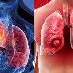 किन कारणों से हो जाता है Lungs Cancer? जानिए इसके इलाज का सही तरीका