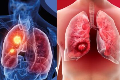 किन कारणों से हो जाता है Lungs Cancer? जानिए इसके इलाज का सही तरीका