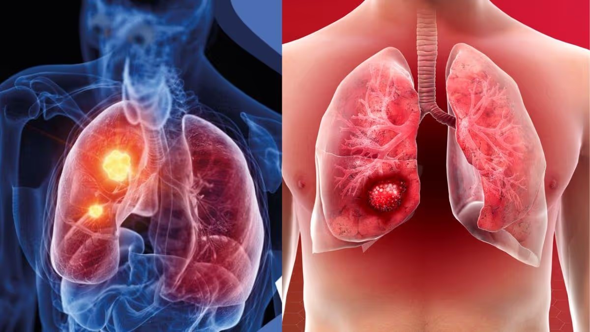 किन कारणों से हो जाता है Lungs Cancer? जानिए इसके इलाज का सही तरीका