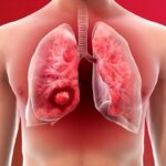 Lungs Cancer: सिगरेट न पीने वाले लोग क्यों हो रहे हैं लंग कैंसर का शिकार