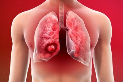 Lungs Cancer: सिगरेट न पीने वाले लोग क्यों हो रहे हैं लंग कैंसर का शिकार