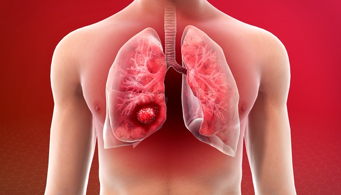 Lungs Cancer: सिगरेट न पीने वाले लोग क्यों हो रहे हैं लंग कैंसर का शिकार