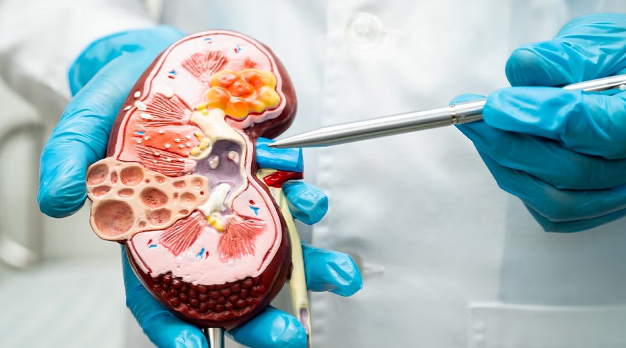 Kidney को हेल्दी रखने के लिए आज ही बनाएं इन चीजों से दूरी, सभी के लिए जानना जरूरी