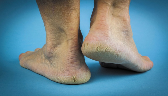 Cracked Heel Repair Tips: मोम के इस्तेमाल से ठीक हो सकती हैं फटी एड़ियां, जानें कैसे?