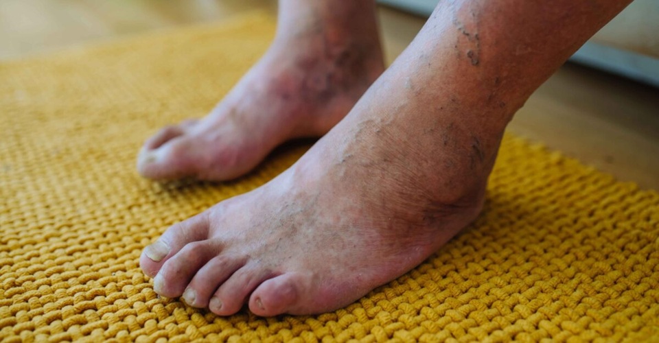 Diabetic Foot: शुगर लेवल अक्सर रहता है बढ़ा, हो जाइए सावधान वरना काटने पड़ सकते हैं पैर