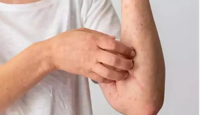 Measles Outbreak: अमेरिका में मामले 700 पार, विशेषज्ञों ने किया सावधान!