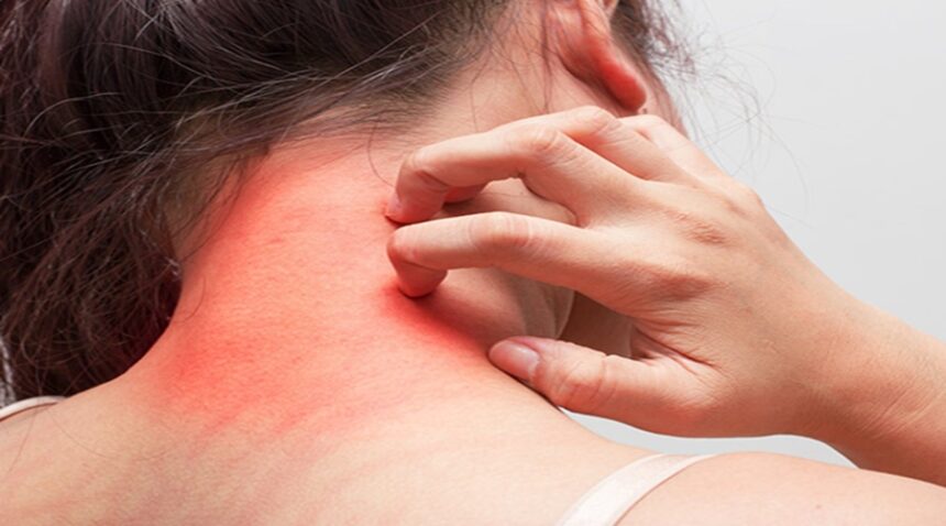 इस विटामिन की कमी से होता है Fungal Infection, जानिए कमी को दूर करने का तरीका