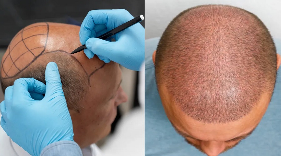Hair Transplant कराने से हुई इंजीनियर की मौत, जानिए इसके साइड इफेक्ट