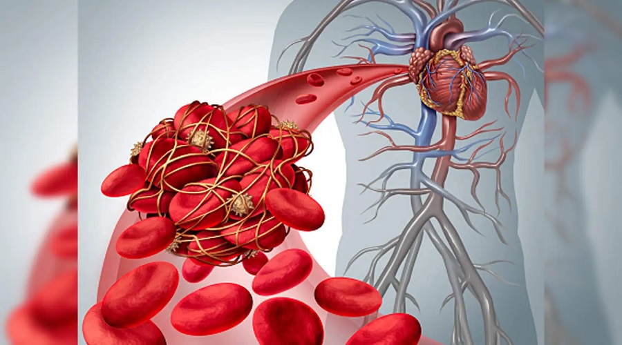 इस Vitamin की कमी से बनता है रक्त का थक्का, जान लीजिए सेहत के लिए फायदेमंद उपाय