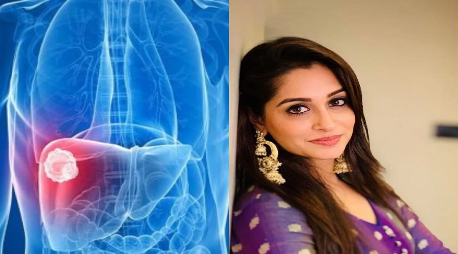 लिवर ट्यूमर का शिकार बनीं TV Actress Dipika Kakar, जानिए कितनी खतरनाक बीमारी है ये?