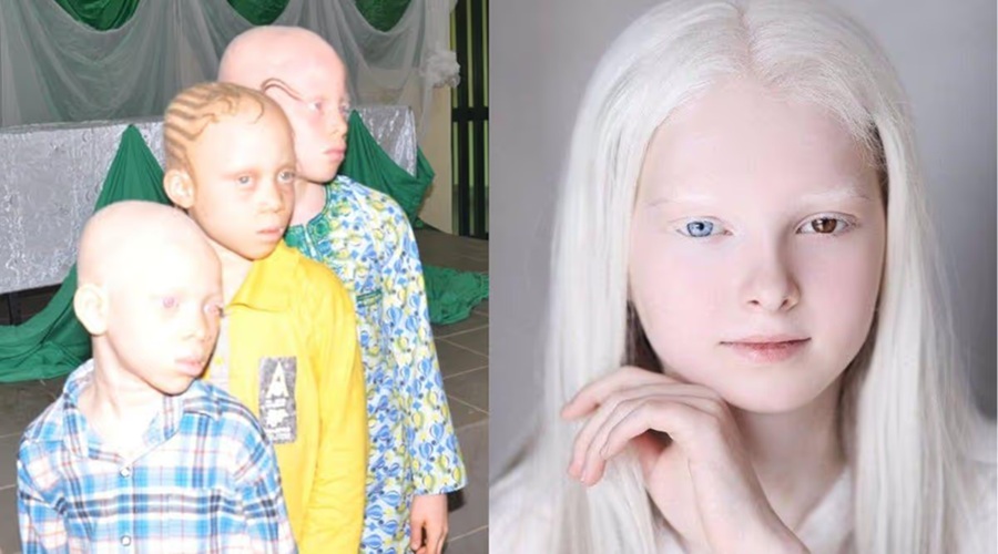International Albinism Day आज, जानें 'सफेद' रंग से जुड़ी बीमारी के बारे में सबकुछ