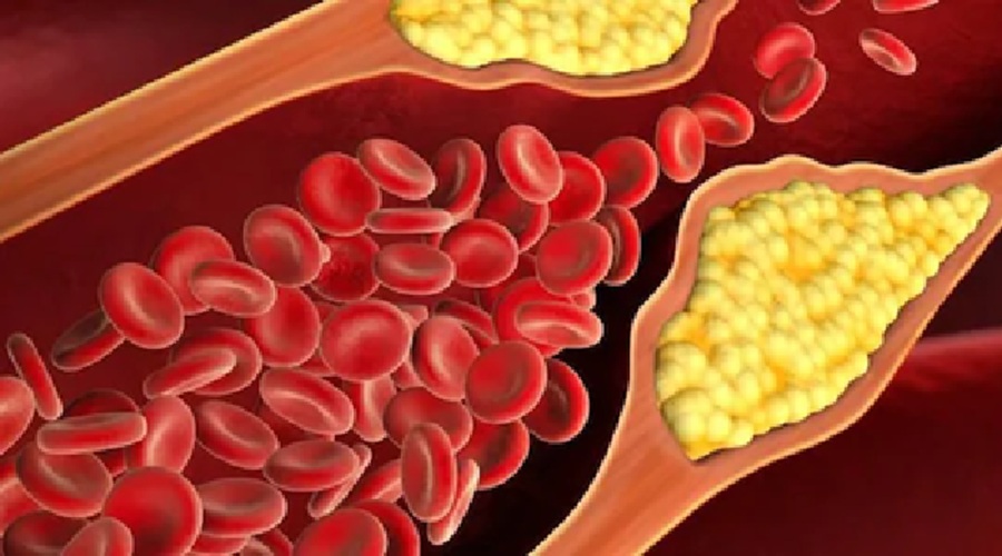 Cholesterol का स्‍तर बढ़ जाता है तो कम करने के लिए अपनाएं ये घरेलू उपाय
