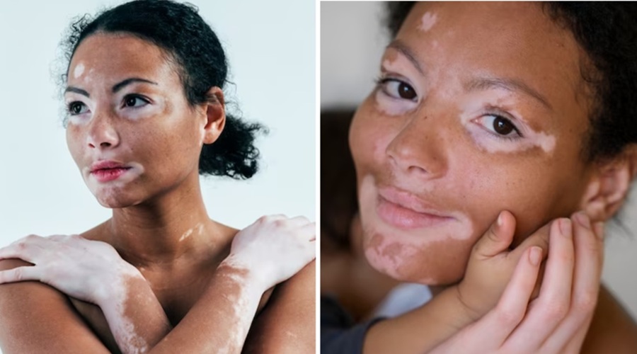 शुरुआत में ही पहचान लें Vitiligo, समय पर इलाज से कंट्रोल हो सकती है यह बीमारी