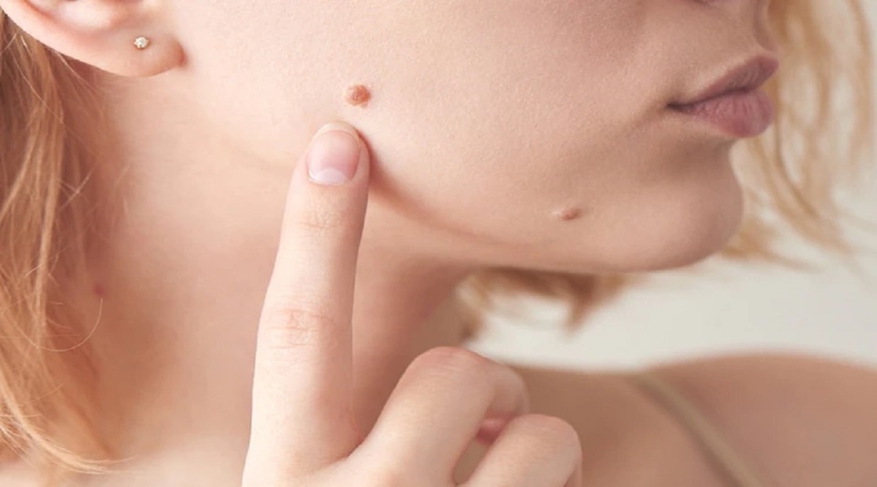 Warts: शरीर पर हो रहें मस्से, जानें क्या है इसके पीछे की वजहें
