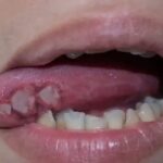 Tongue Cancer Symptoms: जीभ का छाला हो सकता है कैंसर, ये लक्षण दिखे तो तुरंत करा लें जांच
