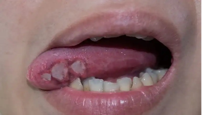 Tongue Cancer Symptoms: जीभ का छाला हो सकता है कैंसर, ये लक्षण दिखे तो तुरंत करा लें जांच
