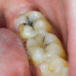 Tooth Cavity: दांतों की कैविटी से पाना है छुटकारा, अपनाएं ये घरेलू उपाय