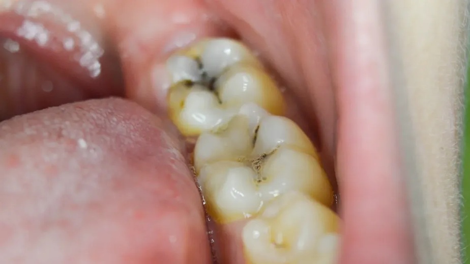 Tooth Cavity: दांतों की कैविटी से पाना है छुटकारा, अपनाएं ये घरेलू उपाय