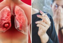 बहुत घातक साबित हो सकता है Lung Cancer, रिस्क फैक्टर्स से हो जाएं सावधान!