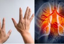 World Lung Cancer Day 2025: 7 संकेतों से चेतावनी देता है फेफड़ों का कैंसर, आप भी करें पहचान