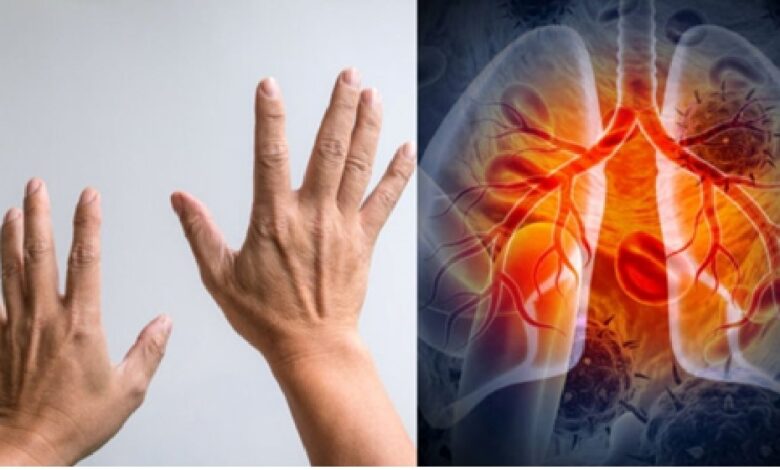 World Lung Cancer Day 2025: 7 संकेतों से चेतावनी देता है फेफड़ों का कैंसर, आप भी करें पहचान