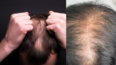 Hair Fall Problem: हर दिन झड़ रहे हैं बाल... तुरंत भागें डॉक्टर के पास