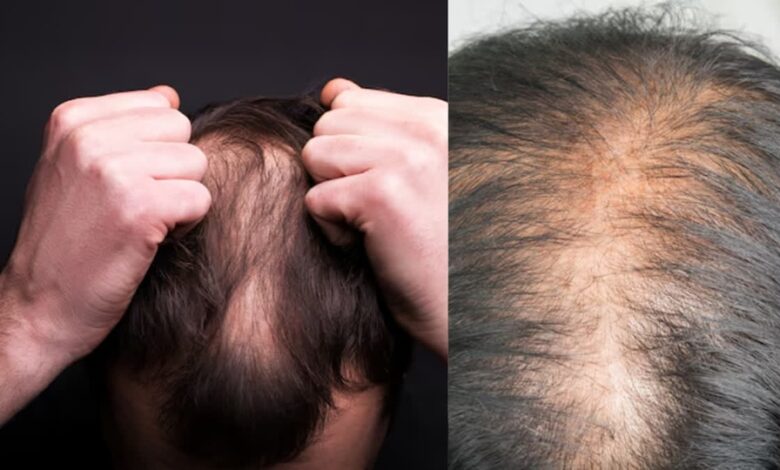 Hair Fall Problem: हर दिन झड़ रहे हैं बाल... तुरंत भागें डॉक्टर के पास