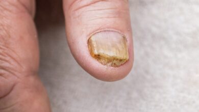 Nail Fungal Infection: बरसात में सड़ने गलने लगे हैं नाखून, करें ये उपाय और आराम पायें