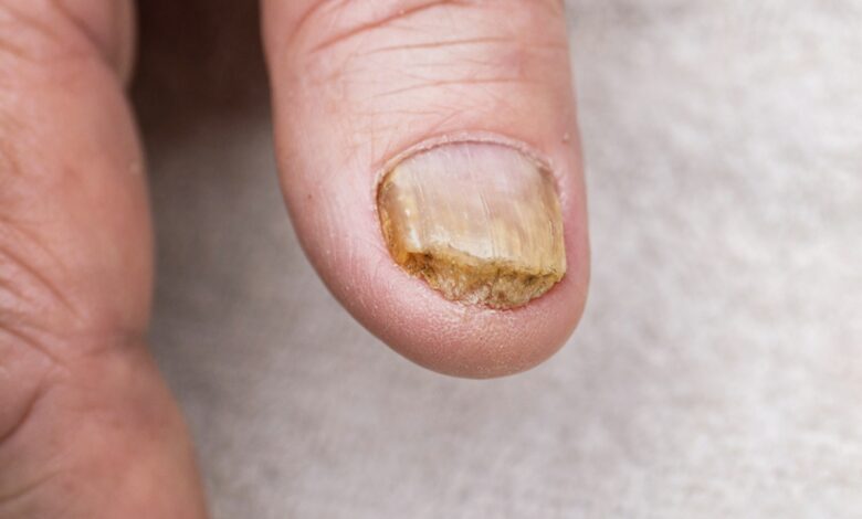 Nail Fungal Infection: बरसात में सड़ने गलने लगे हैं नाखून, करें ये उपाय और आराम पायें