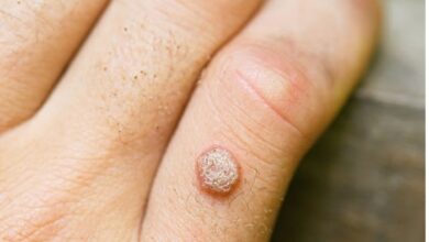 Warts: शरीर में होने वाले मस्सों को न करें नजरअंदाज, जल्द से जल्द कीजिए इनका इलाज