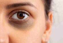 Dark Circles: आपकी आंखों के नीचे भी हो गए हैं काले धब्बे? इसको कभी न करें अनदेखा