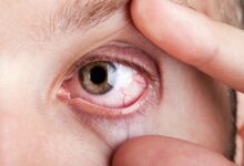 Dry Eyes: समय पर दें ध्यान,नहीं तो हमेशा के लिए जा सकती है रोशनी