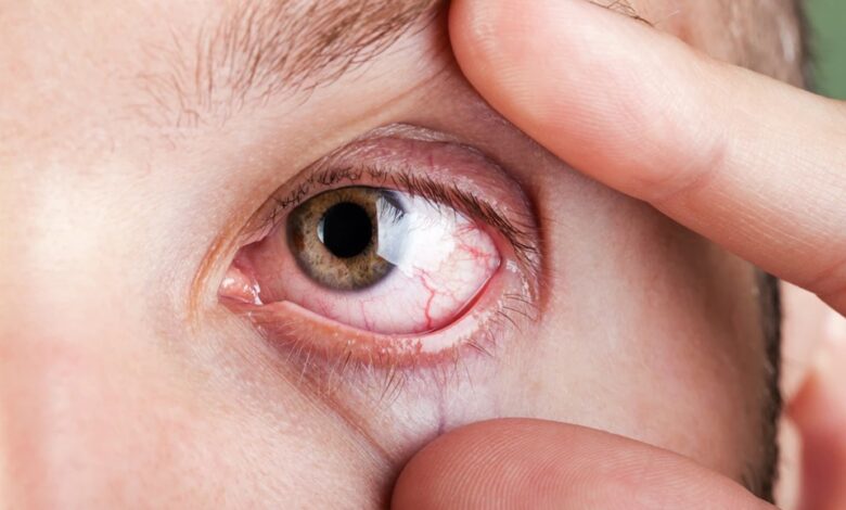 Dry Eyes: समय पर दें ध्यान,नहीं तो हमेशा के लिए जा सकती है रोशनी