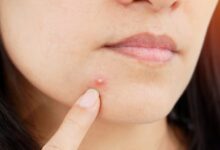 Pimples: इन 5 गलतियों की वजह से बार-बार लौट रहे हैं पिंपल; तुरंत करें सुधार
