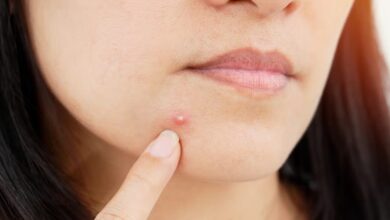 Pimples: इन 5 गलतियों की वजह से बार-बार लौट रहे हैं पिंपल; तुरंत करें सुधार