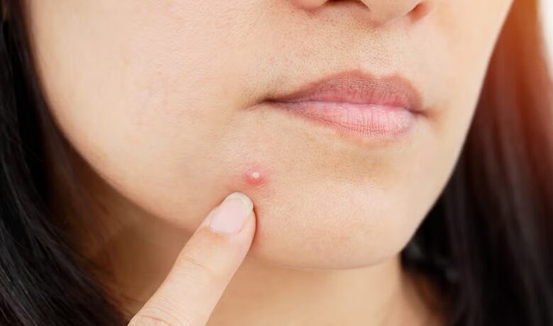 Pimples: इन 5 गलतियों की वजह से बार-बार लौट रहे हैं पिंपल; तुरंत करें सुधार