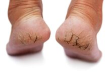 Cracked heels in winter: सर्दियों में इन कारणों से फटती हैं एड़ियां, ऐसे करें घर पर उपचार