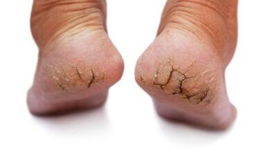Cracked heels in winter: सर्दियों में इन कारणों से फटती हैं एड़ियां, ऐसे करें घर पर उपचार