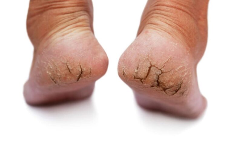 Cracked heels in winter: सर्दियों में इन कारणों से फटती हैं एड़ियां, ऐसे करें घर पर उपचार