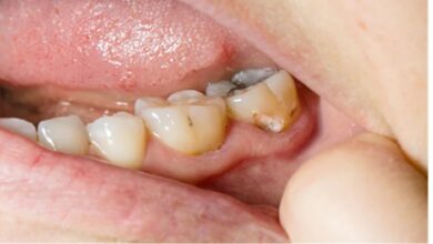 Oral Health: कैविटी सिर्फ दांतों की सड़न नहीं! इलाज नहीं कराया तो बनेगी बड़ी बीमारियों की वजह