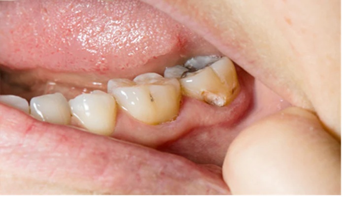 Oral Health: कैविटी सिर्फ दांतों की सड़न नहीं! इलाज नहीं कराया तो बनेगी बड़ी बीमारियों की वजह