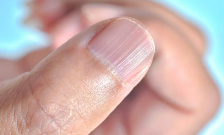 Health Tips: बार-बार नाखून टूटना कैल्शियम की कमी है या फिर कुछ और?