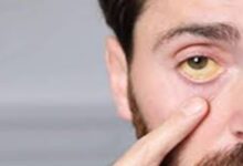 Health Tips: 'पीलिया' के संकेतों के बारे में जानिए, जानें इस बीमारी के शुरुआती लक्षण