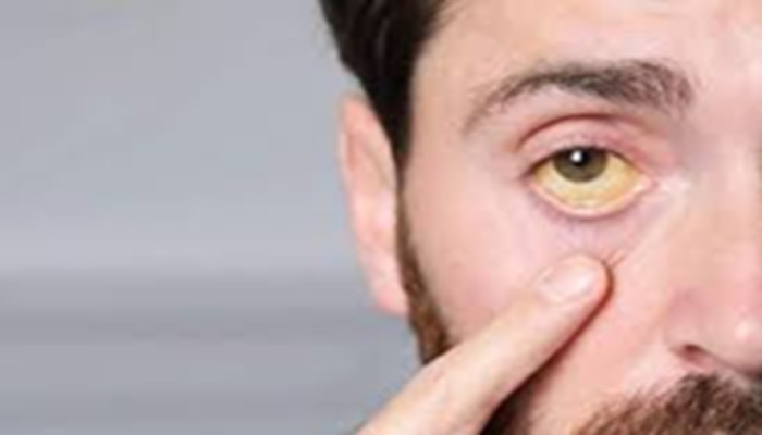 Health Tips: 'पीलिया' के संकेतों के बारे में जानिए, जानें इस बीमारी के शुरुआती लक्षण