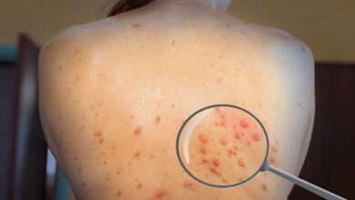 Health Tips: क्या अलग-अलग हैं मंकीपॉक्स और चिकनपॉक्स? इनके लक्षणों से कर सकते हैं पहचान