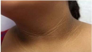 Obesity in Kids: गर्दन पर कालापन सिर्फ मैल नहीं, इस खतरनाक बीमारी की है शुरुआत!